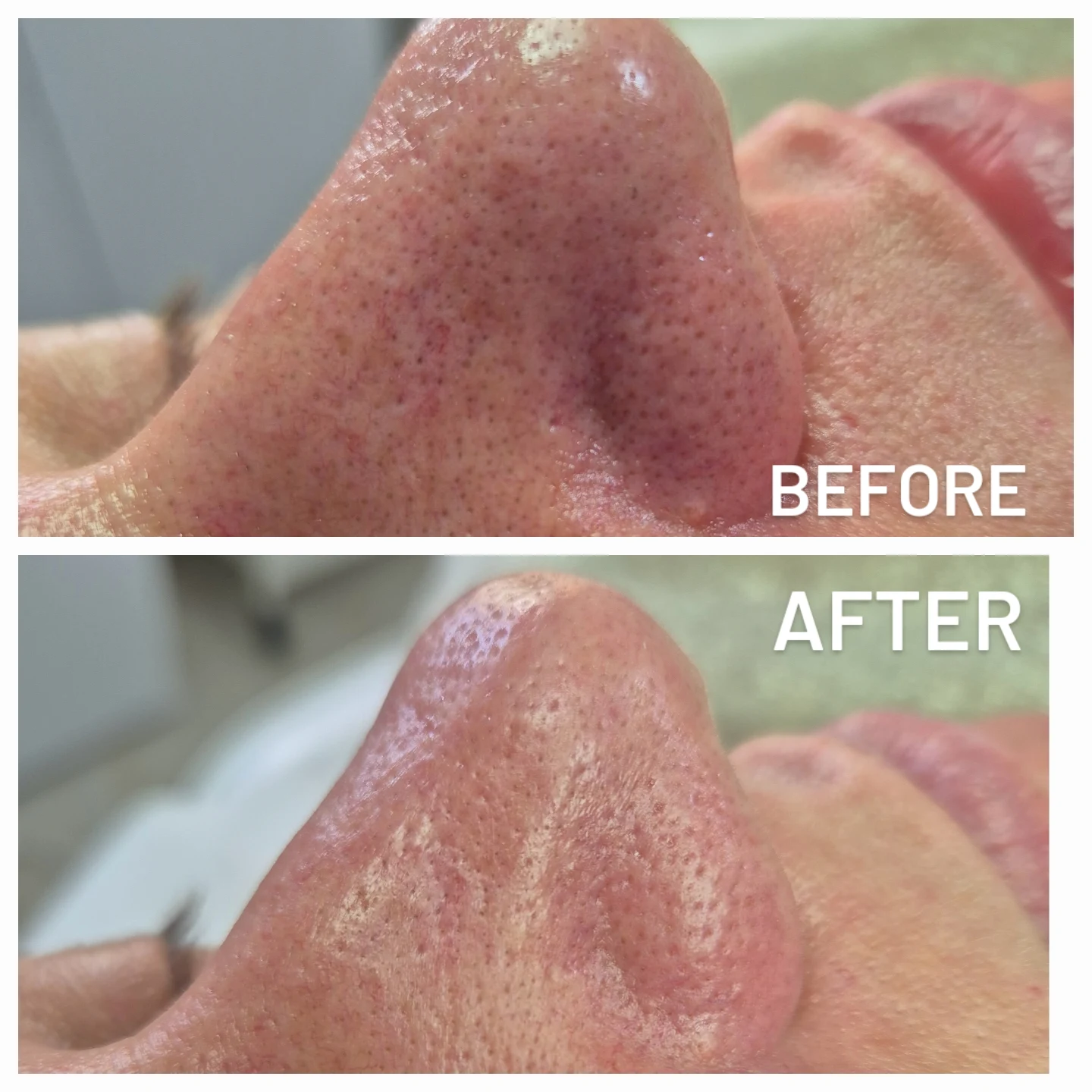 Dubinsko čišćenje pora lica