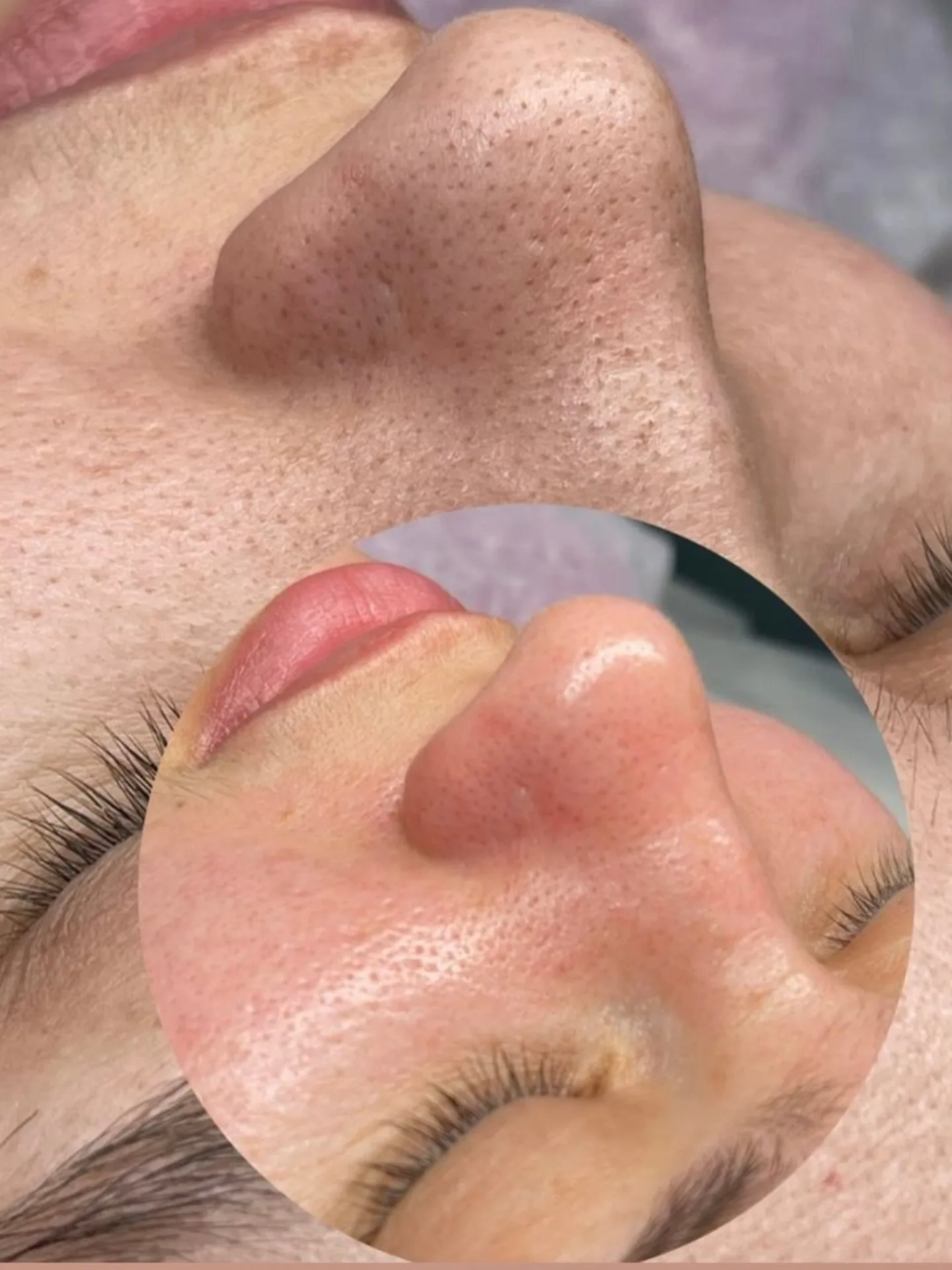 Higijenski tretman lica